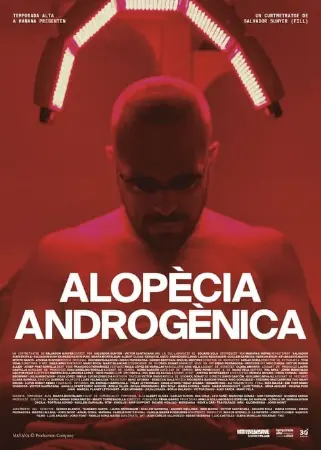 Androgenic Alopecia